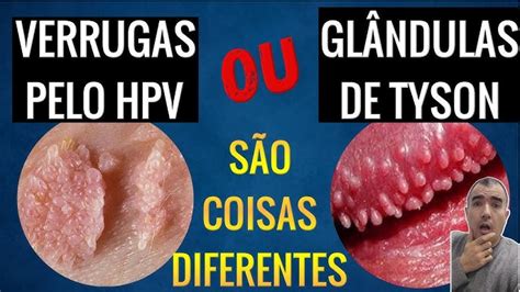 glandulas de tyson ou hpv|Glândulas de Tyson: descubra o que são e sai... 